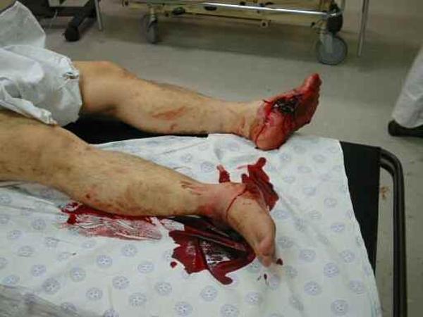 Australskom praktikantu  Davidu Liangu pucali su u nogu u Južnoj Africi u lipnju 2004. godine.