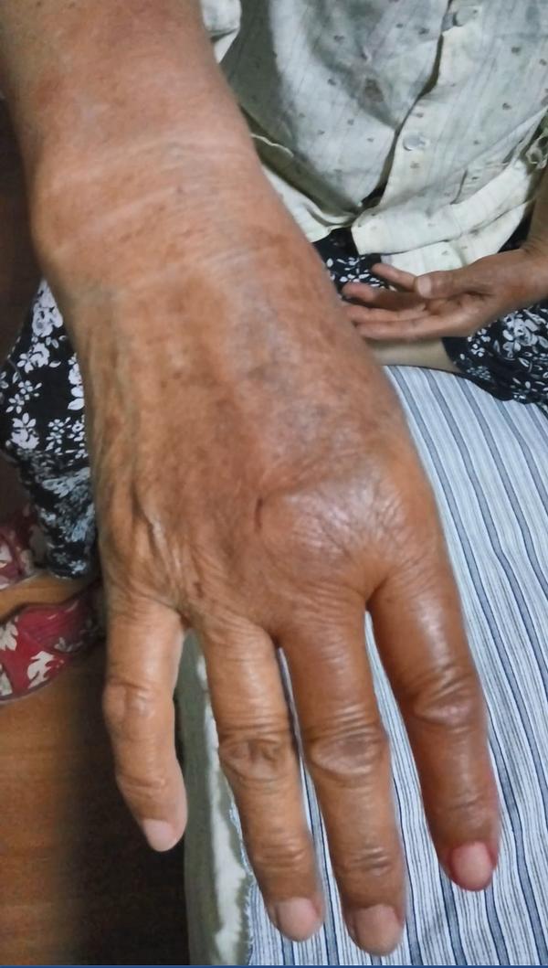 Prsti gospođe Jiang su natekli i potamnili nakon policijskog zlostavljanja u pritvoru.
 