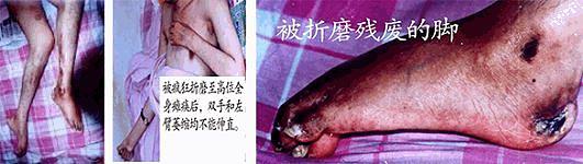 Kao rezultat paralize, gospodin Ku nije mogao da ispravi ruke i levu nogu. Noga mu je takođe bila onesposobljena (desna).