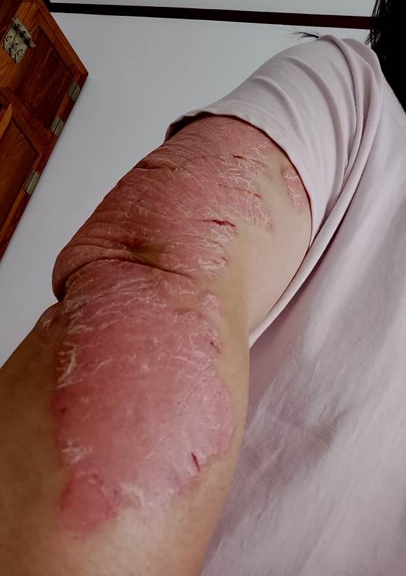 Moja desna ruka prekrivena psorijazom pre nego što sam započela praksu Falun Dafe