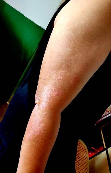 Psorijaza je sada skoro nestala.